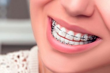 Qué tipos de ortodoncia hay y en qué casos están recomendados