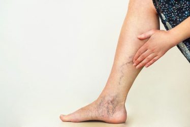 Se me notan mucho las venas de las piernas: ¿qué puedo hacer?